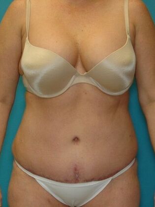 After Image: Abdominoplasty: Case 11 - front