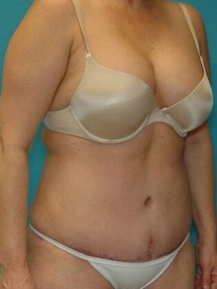 After Image: Abdominoplasty: Case 11 - right-front-oblique