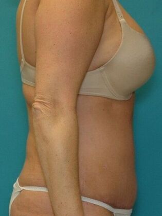 After Image: Abdominoplasty: Case 11 - right-side