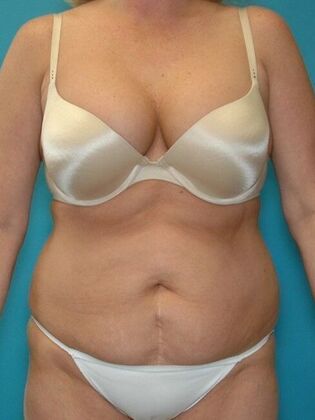 Before Image: Abdominoplasty: Case 11 - front