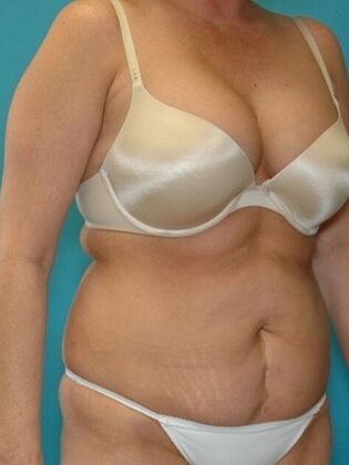 Before Image: Abdominoplasty: Case 11 - right-front-oblique