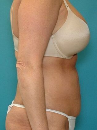 Before Image: Abdominoplasty: Case 11 - right-side