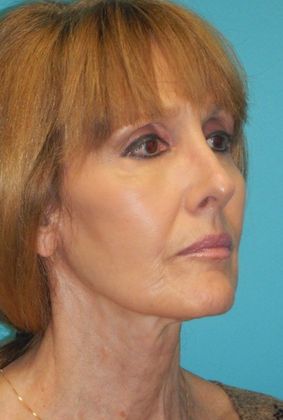 After Image: Mini Facelift: Case 11 - right-front-oblique