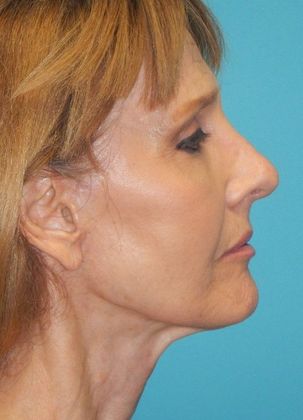 After Image: Mini Facelift: Case 11 - right-side