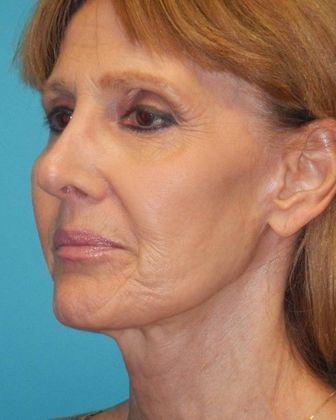 After Image: Mini Facelift: Case 11 - left-front-oblique