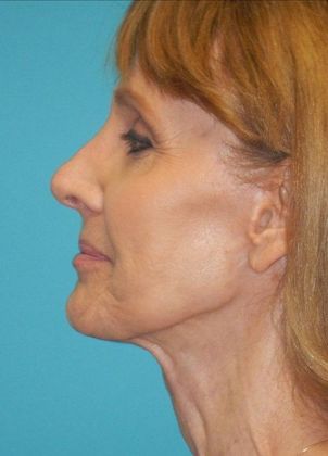 After Image: Mini Facelift: Case 11 - left-side