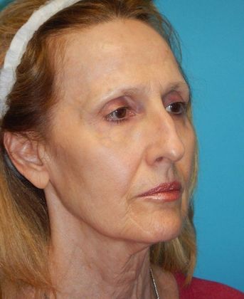 Before Image: Mini Facelift: Case 11 - right-front-oblique