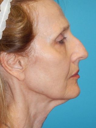Before Image: Mini Facelift: Case 11 - right-side