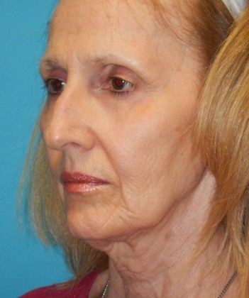 Before Image: Mini Facelift: Case 11 - left-front-oblique
