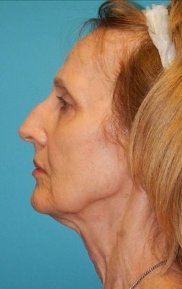 Before Image: Mini Facelift: Case 11 - left-side