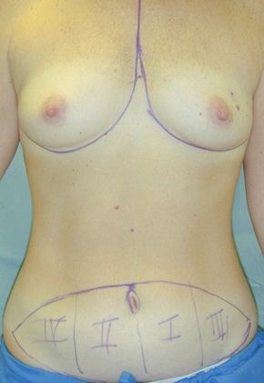 Before Image: Breast Reconstruction: Case 11 - front