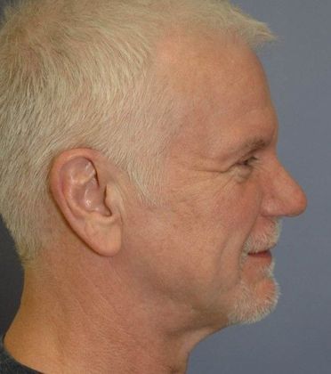After Image: Eye Lift (Blepharoplasty): Case 11 - right-side