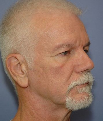 Before Image: Eye Lift (Blepharoplasty): Case 11 - right-front-oblique