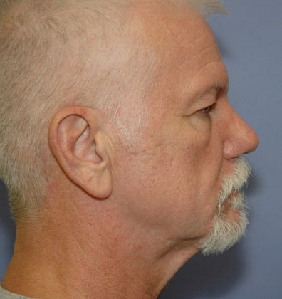 Before Image: Eye Lift (Blepharoplasty): Case 11 - right-side