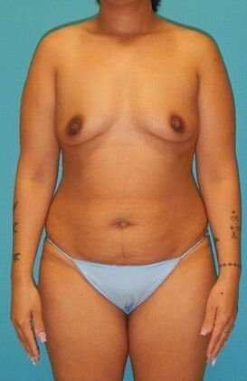 Before Image: Breast Lift Augmentation: Case 11 - front