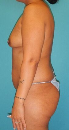 Before Image: Breast Lift Augmentation: Case 11 - left-side