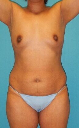 Before Image: Breast Lift Augmentation: Case 11 - front