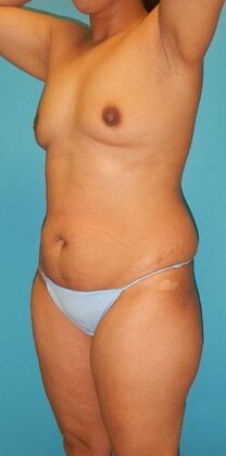 Before Image: Breast Lift Augmentation: Case 11 - left-front-oblique