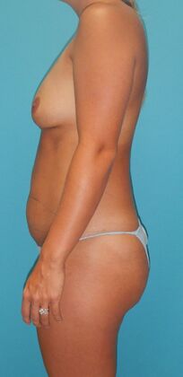 Before Image: Mommy Makeover: Case 11 - left-side