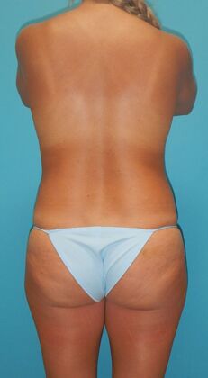 Before Image: Mommy Makeover: Case 11 - back