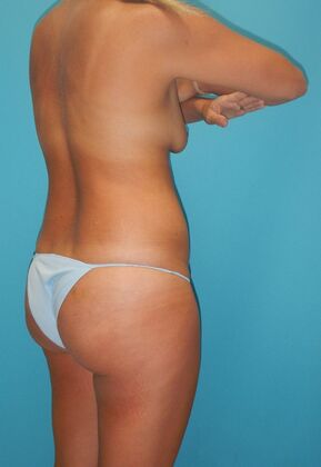 Before Image: Mommy Makeover: Case 11 - right-back-oblique