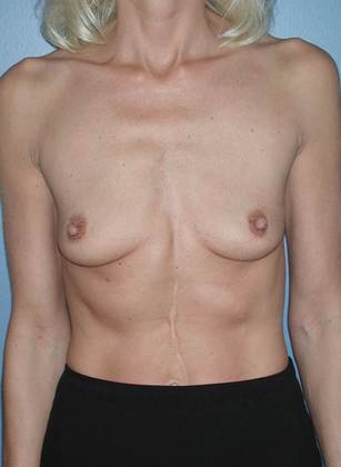 Before Image: Breast Augmentation: Case 12 - front