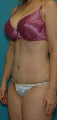 After Image: Abdominoplasty: Case 12 - left-front-oblique