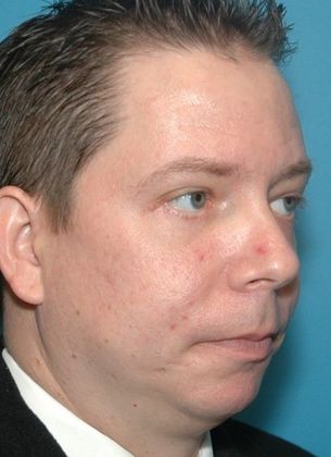 After Image: Eye Lift (Blepharoplasty): Case 12 - right-front-oblique