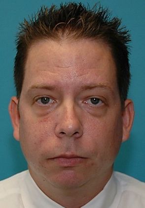 Before Image: Eye Lift (Blepharoplasty): Case 12 - front