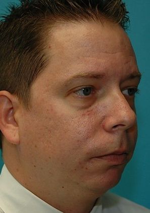 Before Image: Eye Lift (Blepharoplasty): Case 12 - right-front-oblique