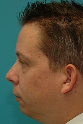 Before Image: Eye Lift (Blepharoplasty): Case 12 - left-side