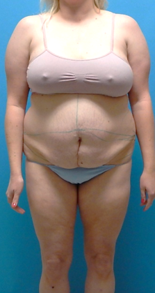 After Image: Abdominoplasty: Case 13 - front