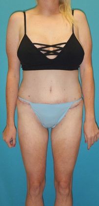 Before Image: Abdominoplasty: Case 13 - front