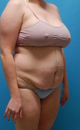 Before Image: Abdominoplasty: Case 13 - right-front-oblique