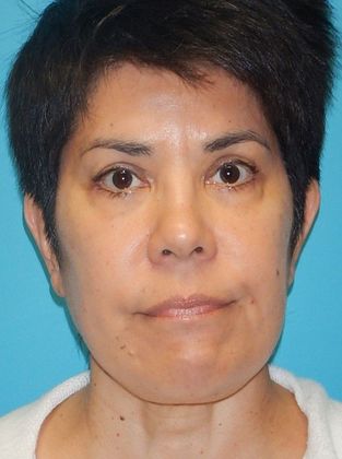 After Image: Eye Lift (Blepharoplasty): Case 13 - front