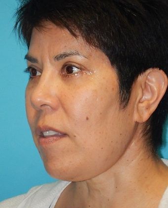 After Image: Eye Lift (Blepharoplasty): Case 13 - left-front-oblique