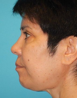 After Image: Eye Lift (Blepharoplasty): Case 13 - left-side