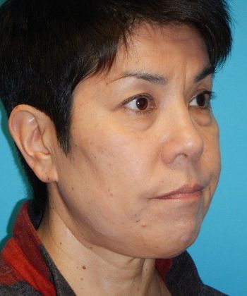 After Image: Eye Lift (Blepharoplasty): Case 13 - right-front-oblique