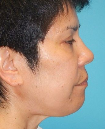 After Image: Eye Lift (Blepharoplasty): Case 13 - right-side
