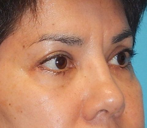 After Image: Eye Lift (Blepharoplasty): Case 13 - right-front-oblique
