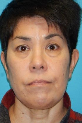 Before Image: Eye Lift (Blepharoplasty): Case 13 - front
