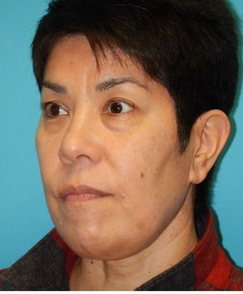 Before Image: Eye Lift (Blepharoplasty): Case 13 - left-front-oblique