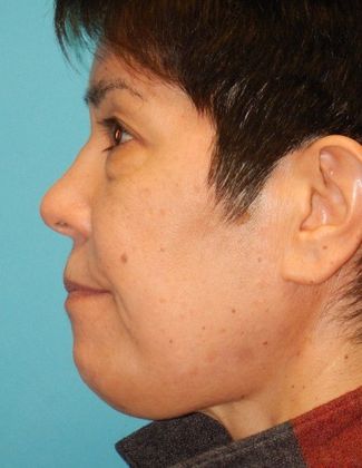 Before Image: Eye Lift (Blepharoplasty): Case 13 - left-side