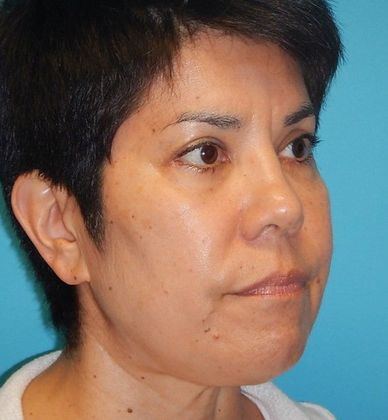 Before Image: Eye Lift (Blepharoplasty): Case 13 - right-front-oblique