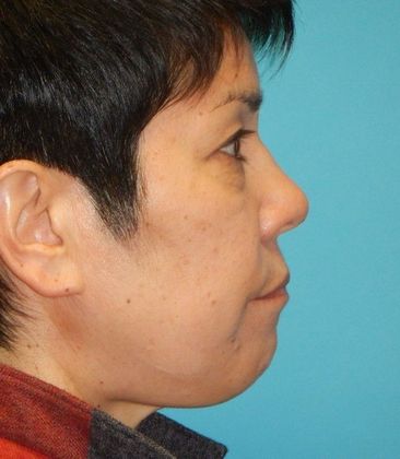 Before Image: Eye Lift (Blepharoplasty): Case 13 - right-side