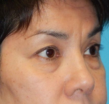 Before Image: Eye Lift (Blepharoplasty): Case 13 - right-front-oblique