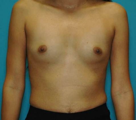Before Image: Breast Augmentation: Case 14 - front