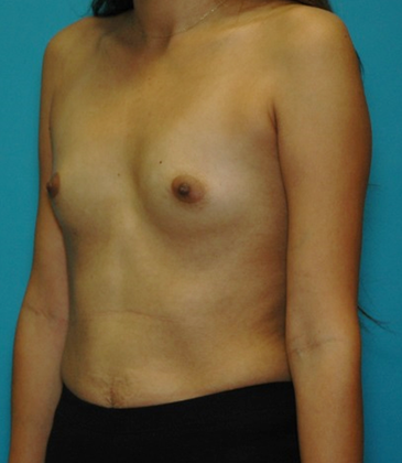 Before Image: Breast Augmentation: Case 14 - left-front-oblique