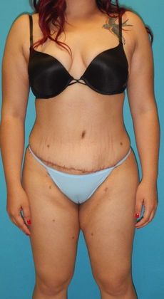 After Image: Abdominoplasty: Case 14 - front