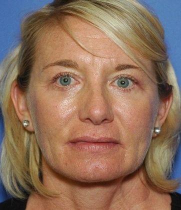 After Image: Eye Lift (Blepharoplasty): Case 14 - front